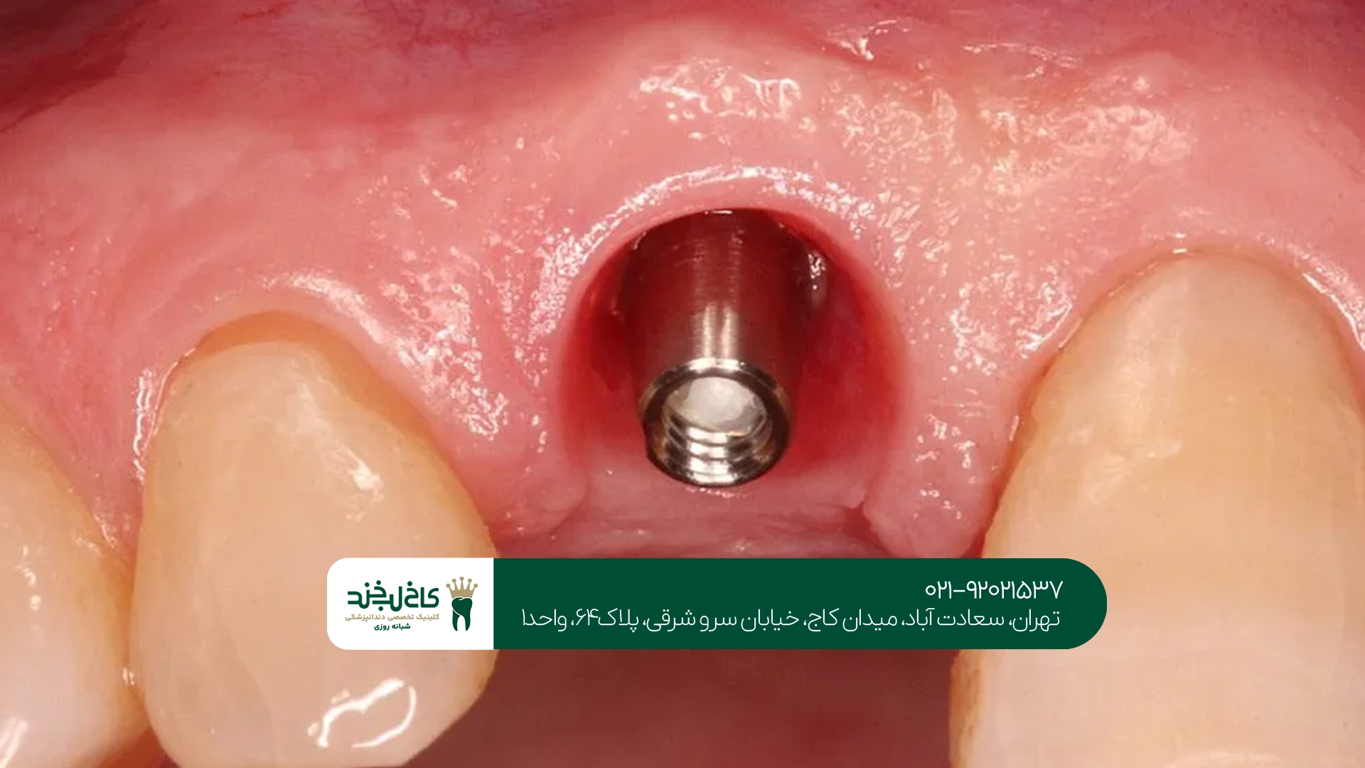 مرکز ایمپلنت اقساطی تهران