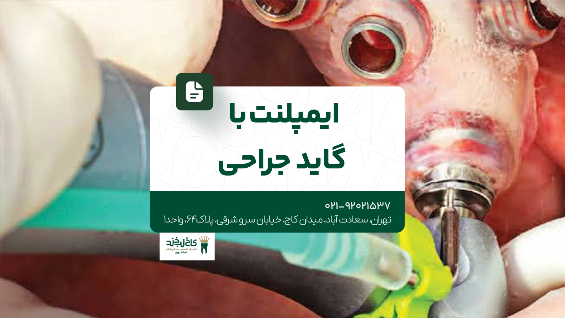 ایمپلنت با گاید جراحی ایمپلنت با گاید جراحی