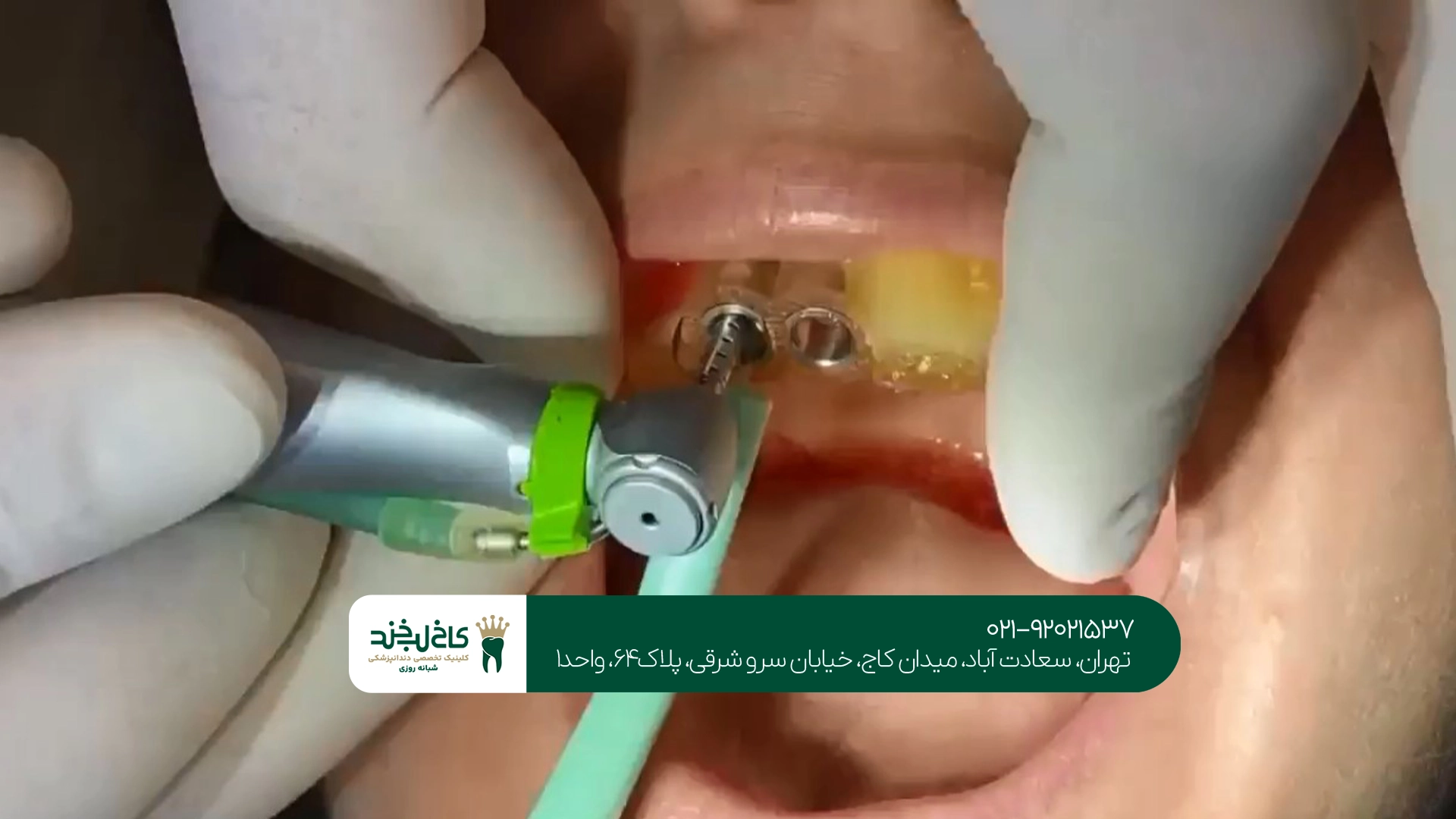 مزایای ایمپلنت با گاید جراحی نسبت به روش معمولی مزایای ایمپلنت با گاید جراحی نسبت به روش معمولی