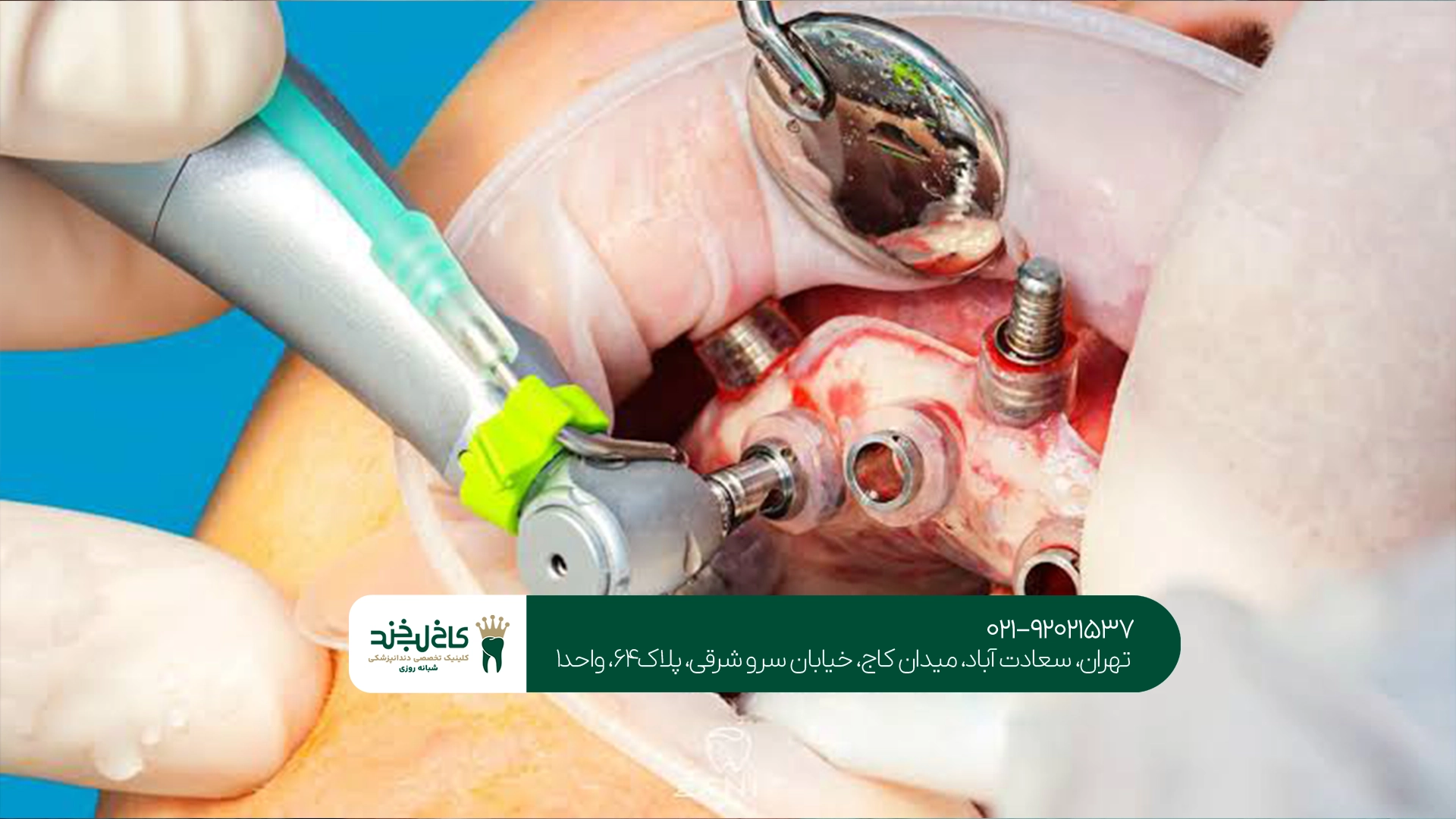 بهترین مرکز ایمپلنت با گاید جراحی بهترین مرکز ایمپلنت با گاید جراحی