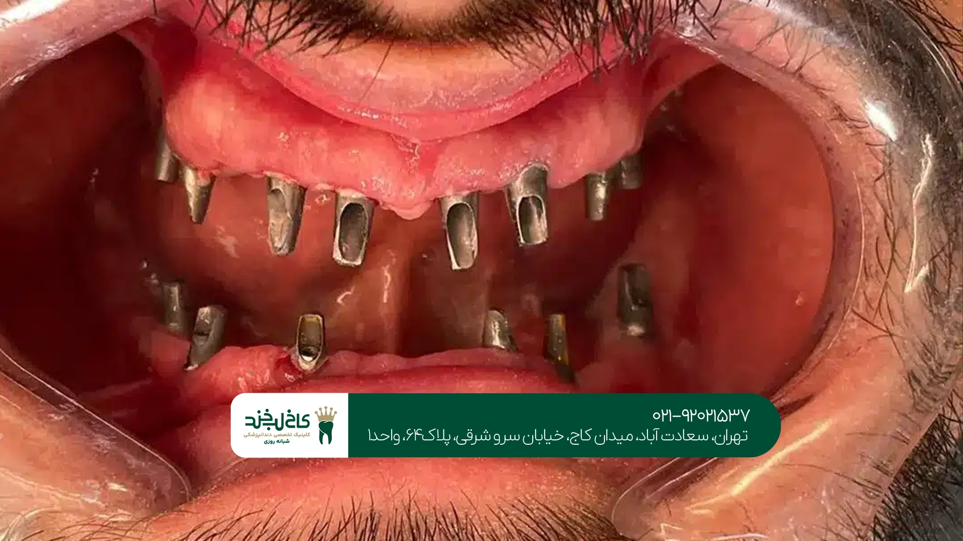 مراحل انجام ایمپلنت بدون درد مراحل انجام ایمپلنت بدون درد