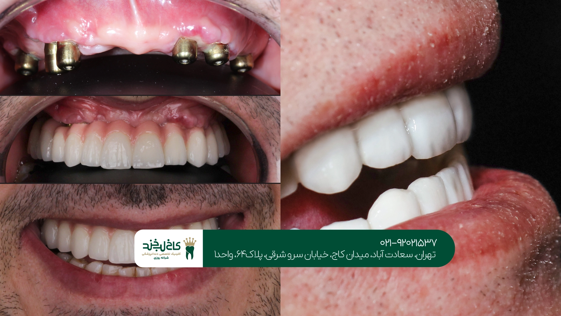 روشهای کاهش درد در ایمپلنت دندان روشهای کاهش درد در ایمپلنت دندان