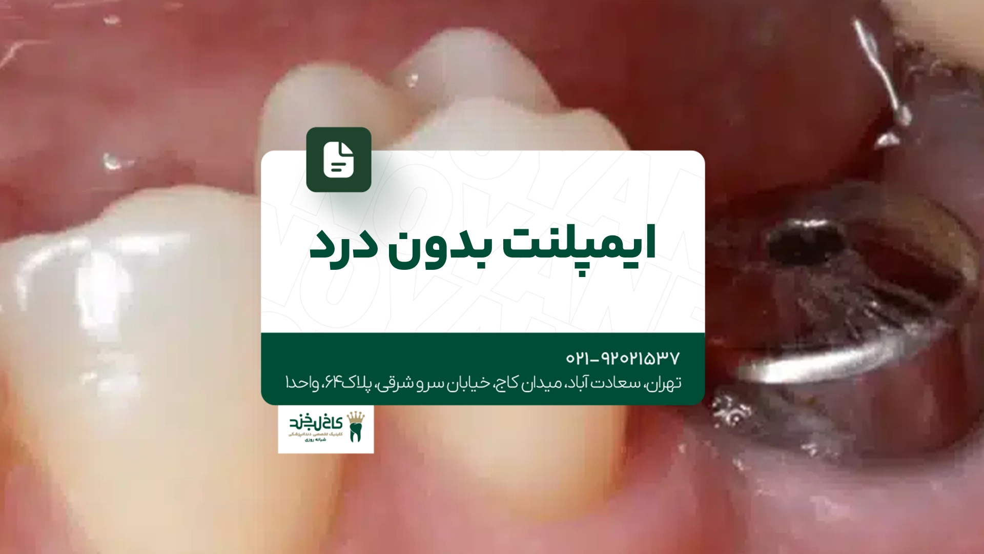 ایمپلنت بدون درد ایمپلنت بدون درد