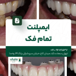 ایمپلنت تمام فک