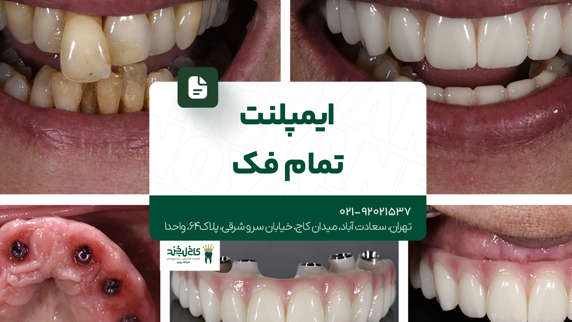 ایمپلنت تمام فک