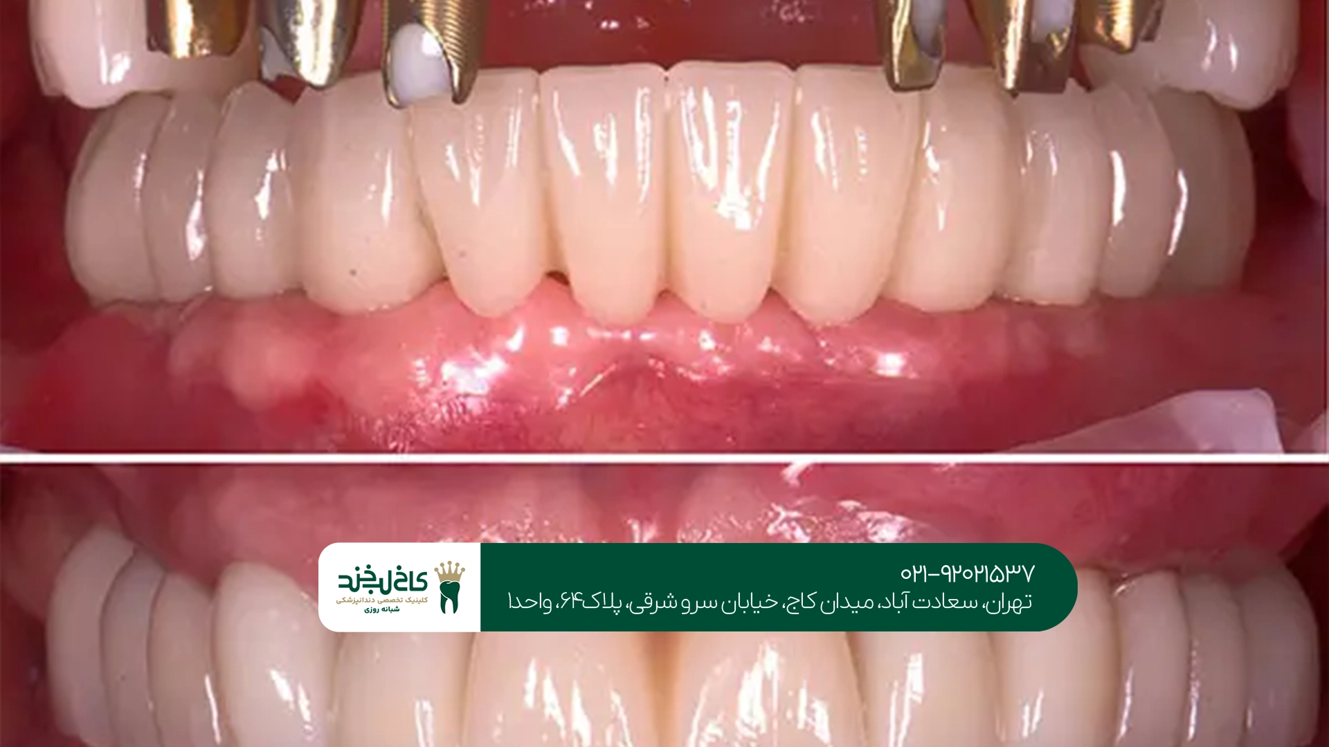 بهترین کلینیک ایمپلنت تمام فک