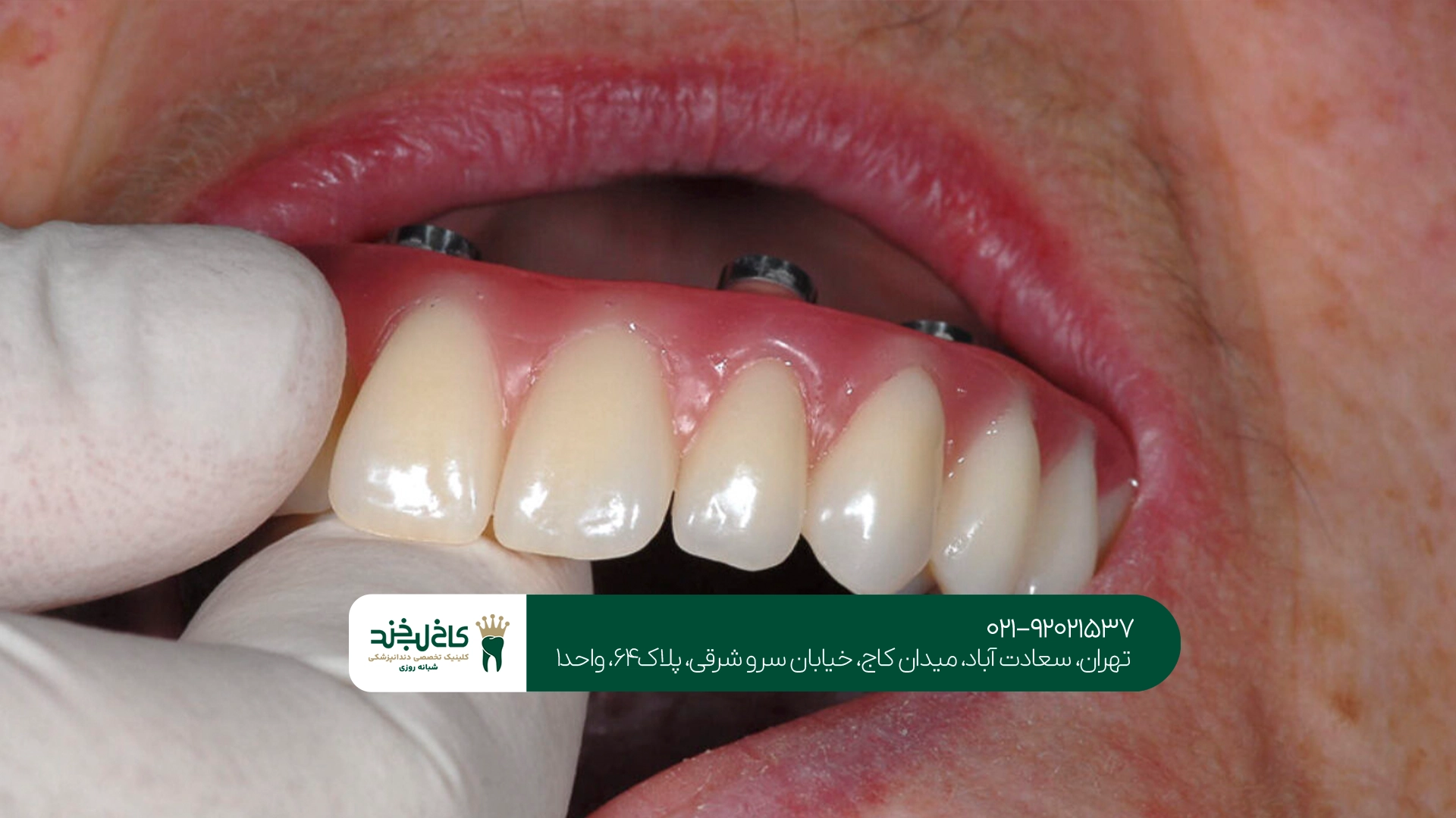 بهترین مرکز بازسازی کامل دندانها