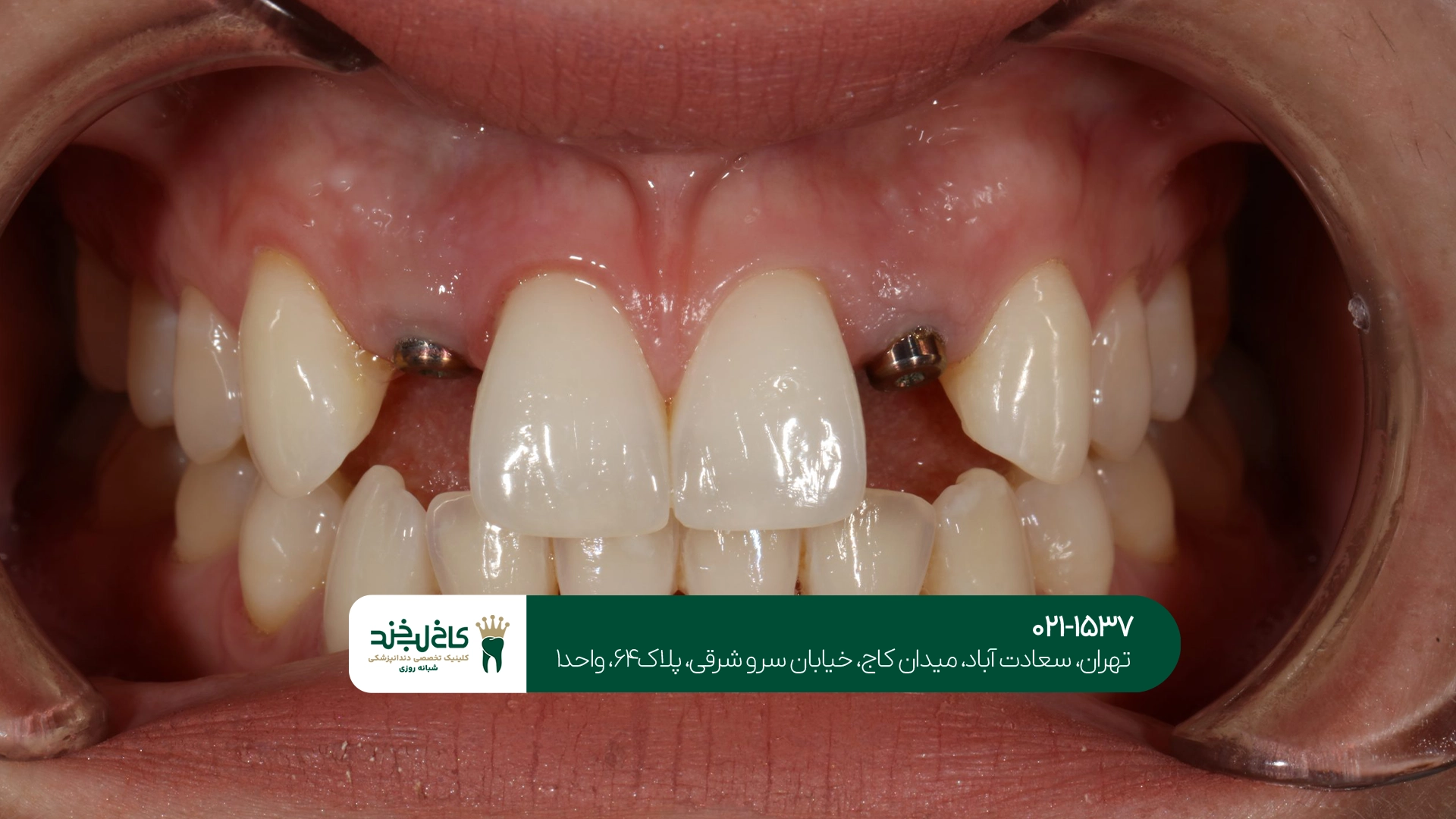 کلینیک تخصصی ایمپلنت تک دندان