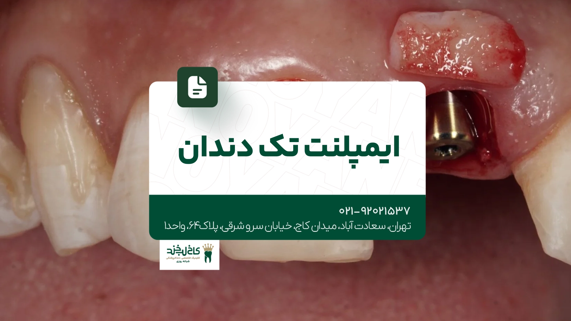 ایمپلنت تک دندان