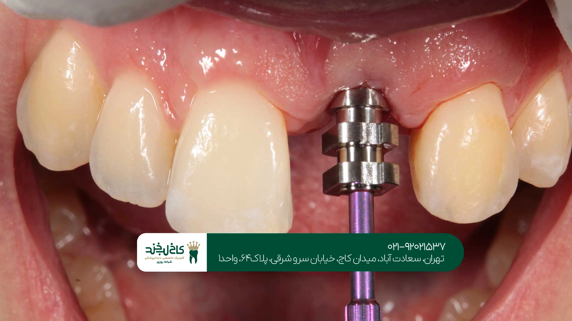 کلینیک ایمپلنت دندان با پرداخت قسطی