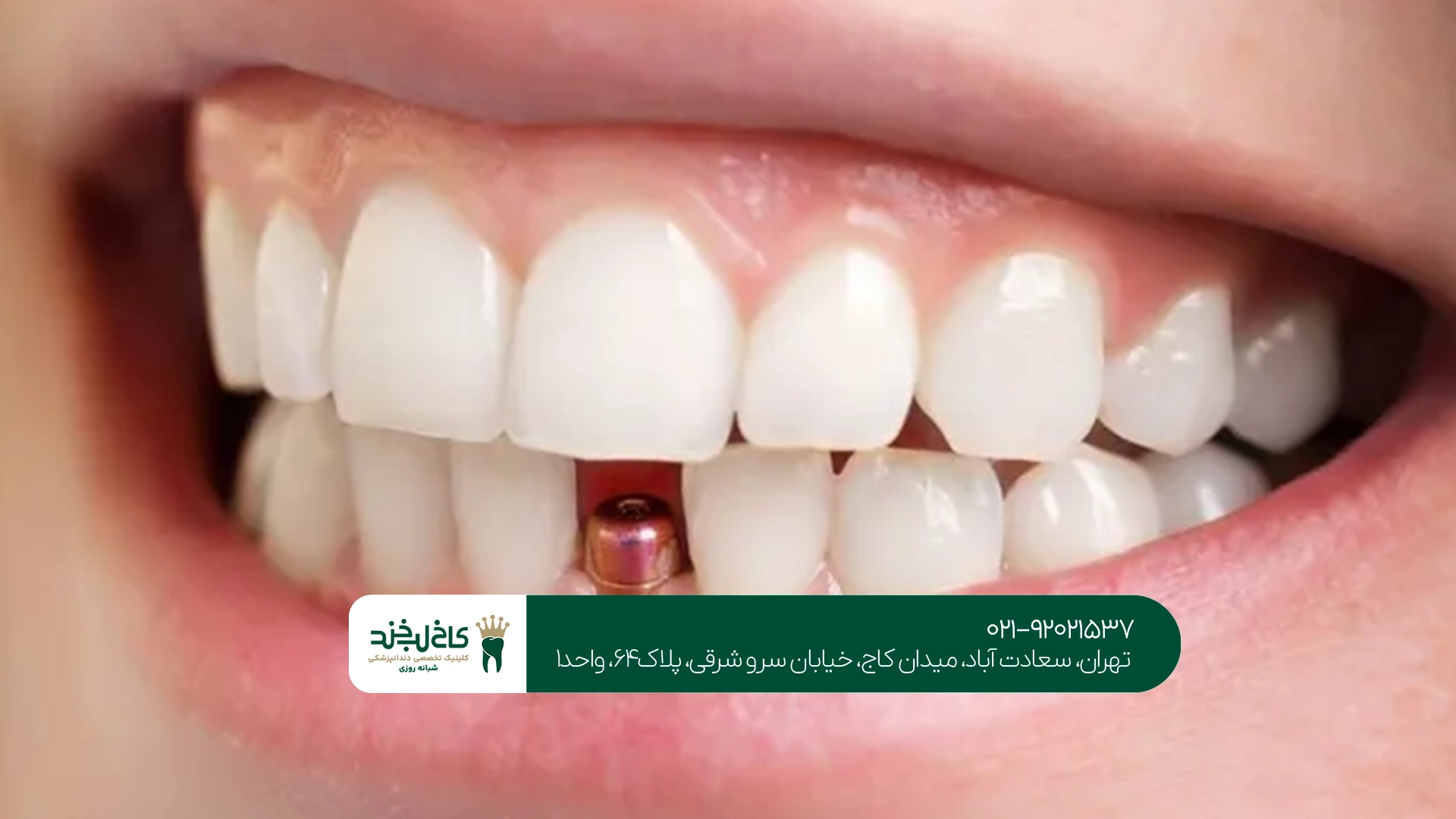 کلینیک ایمپلنت اقساطی در تهران
