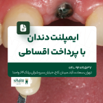 ایمپلنت دندان با پرداخت قسطی