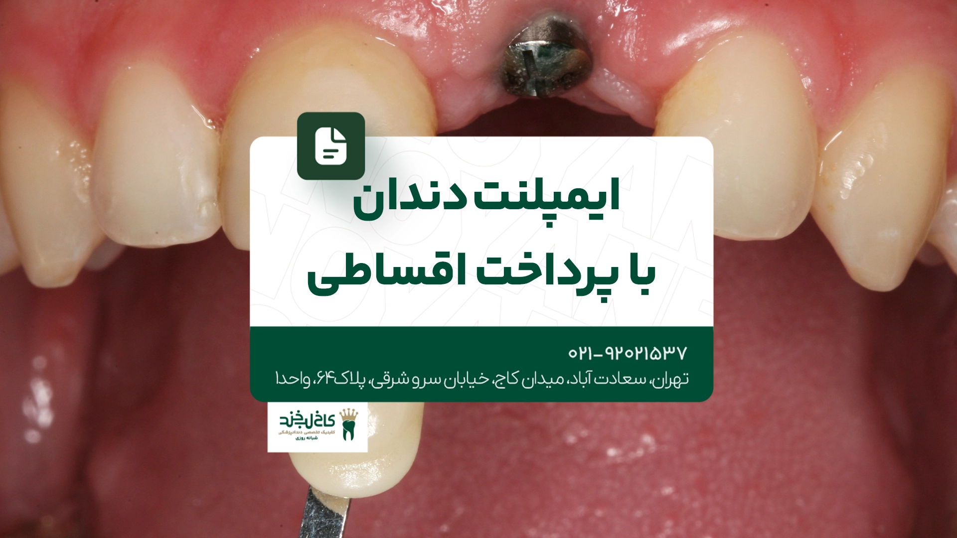 ایمپلنت دندان با پرداخت قسطی