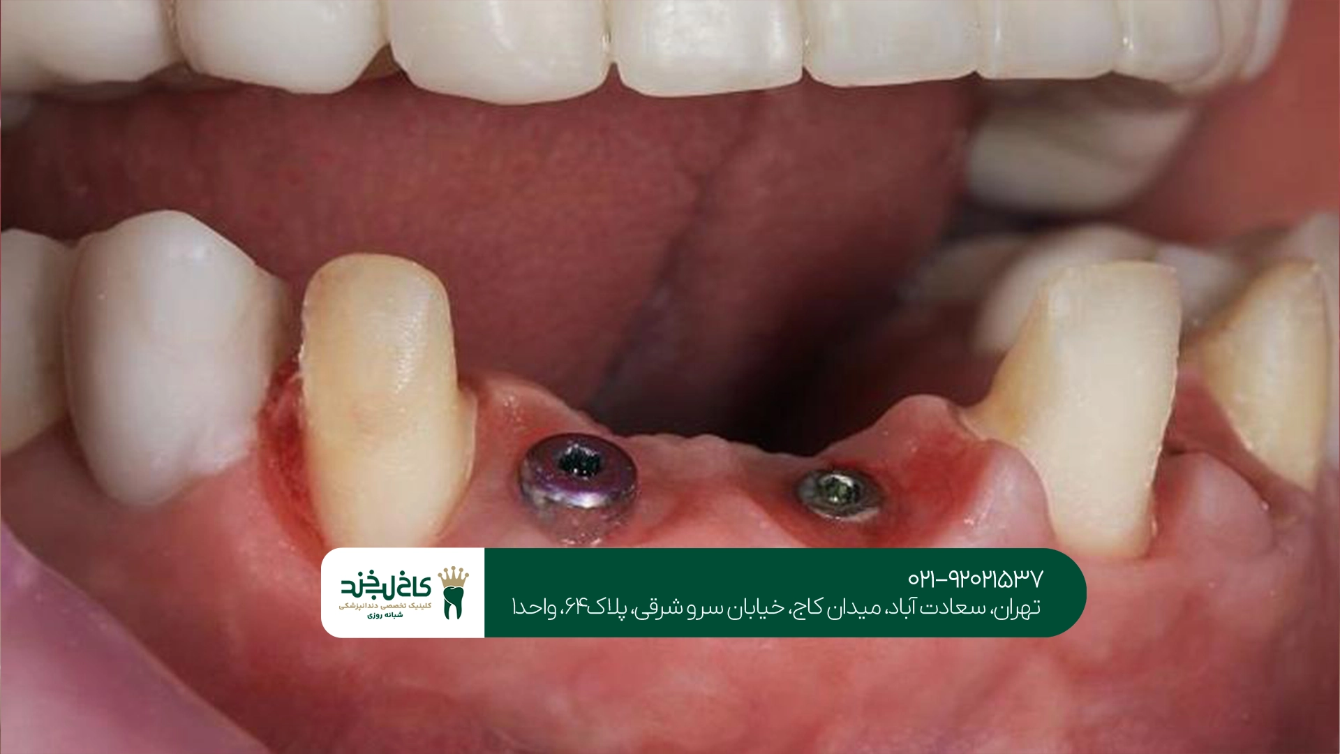 ایمپلنت دندان بدون درد تهران
