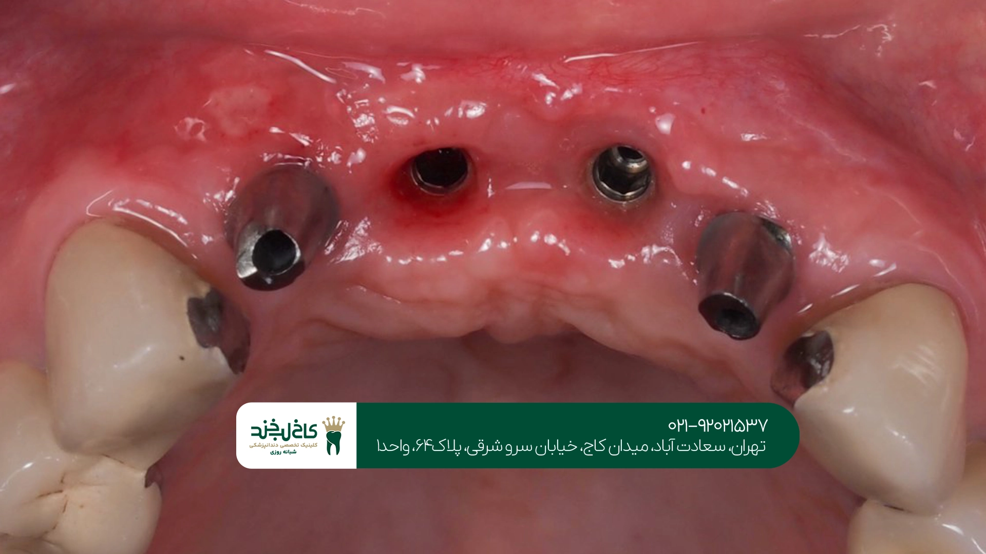 ماندگاری ایمپلنت دندان چقدر است؟