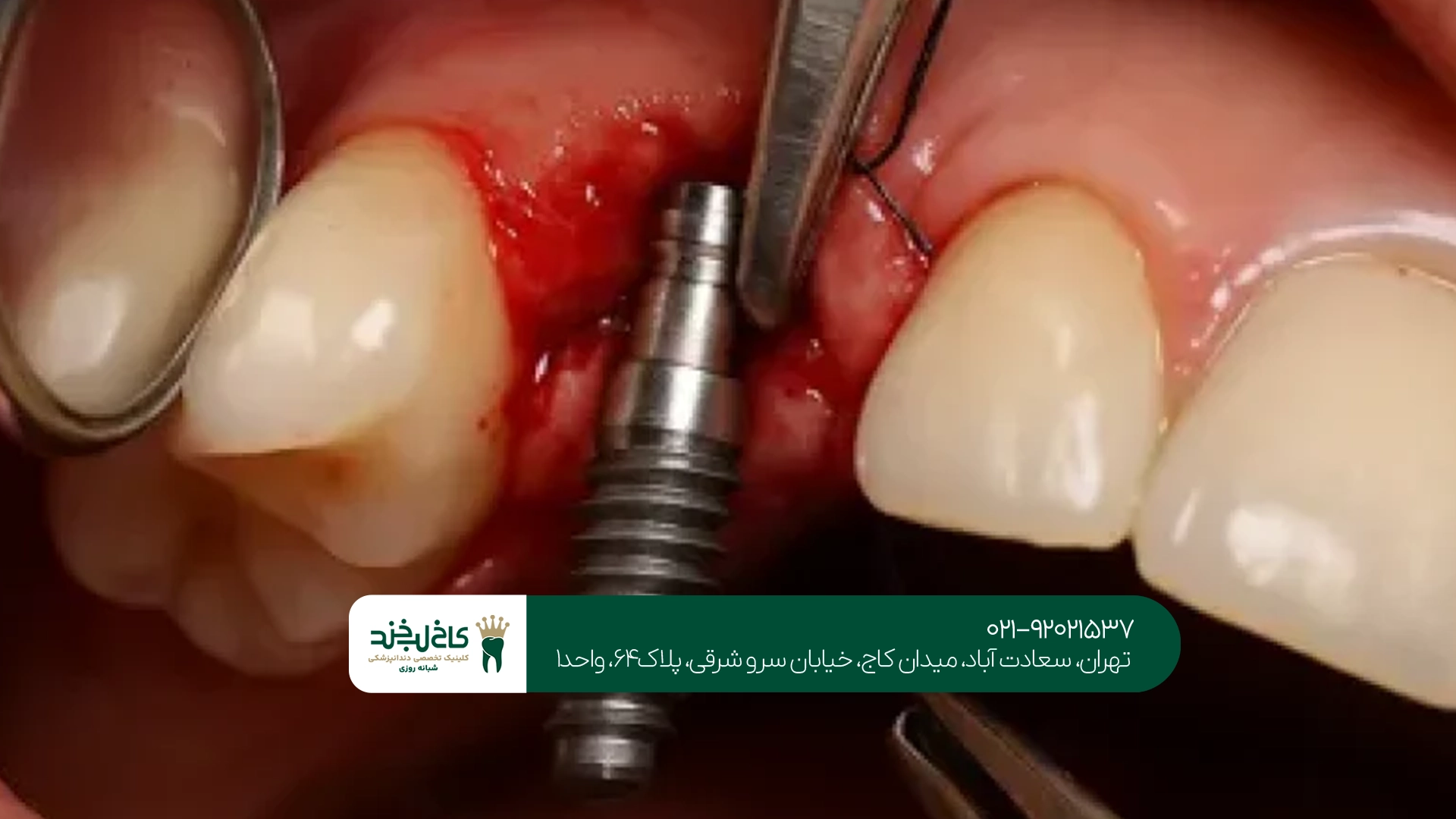 هزینه ایمپلنت دندان تهران به چه عواملی بستگی دارد؟