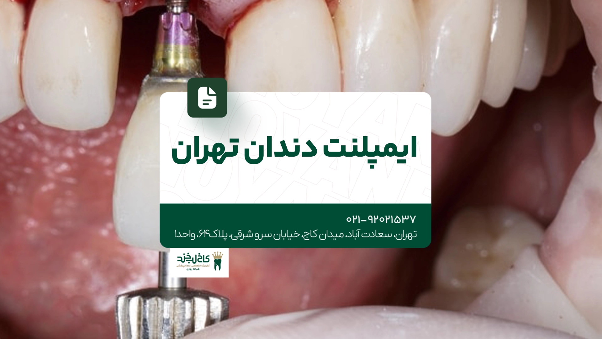 ایمپلنت دندان تهران