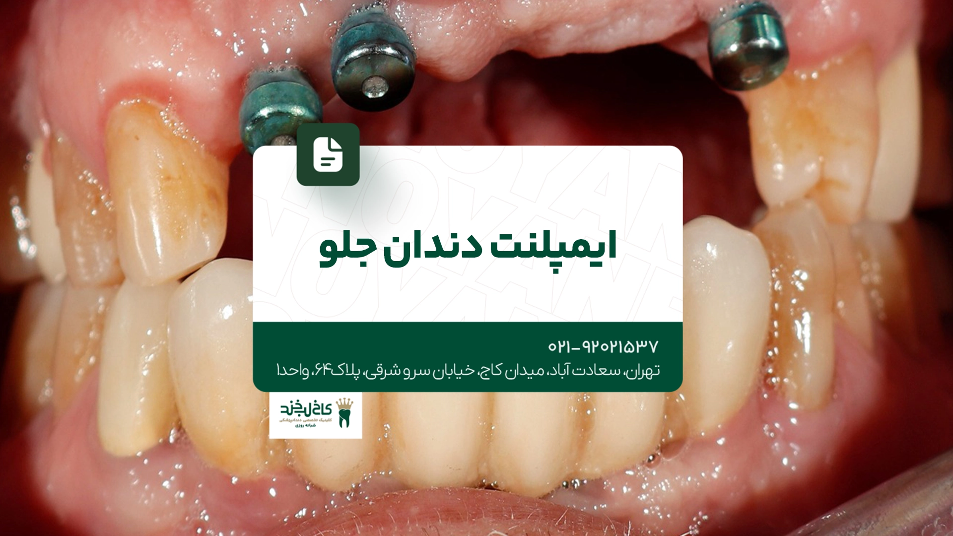 ایمپلنت دندان جلو