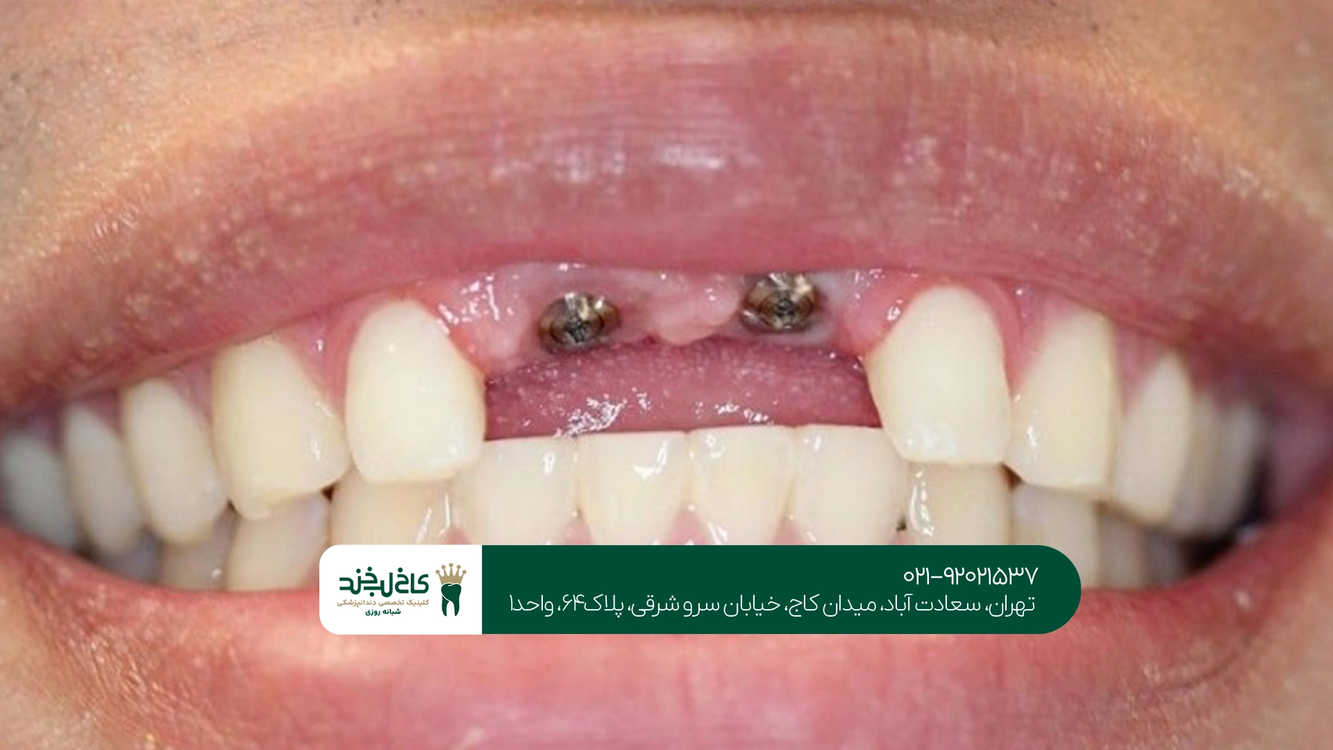 مرکز تخصصی ایمپلنت دندان