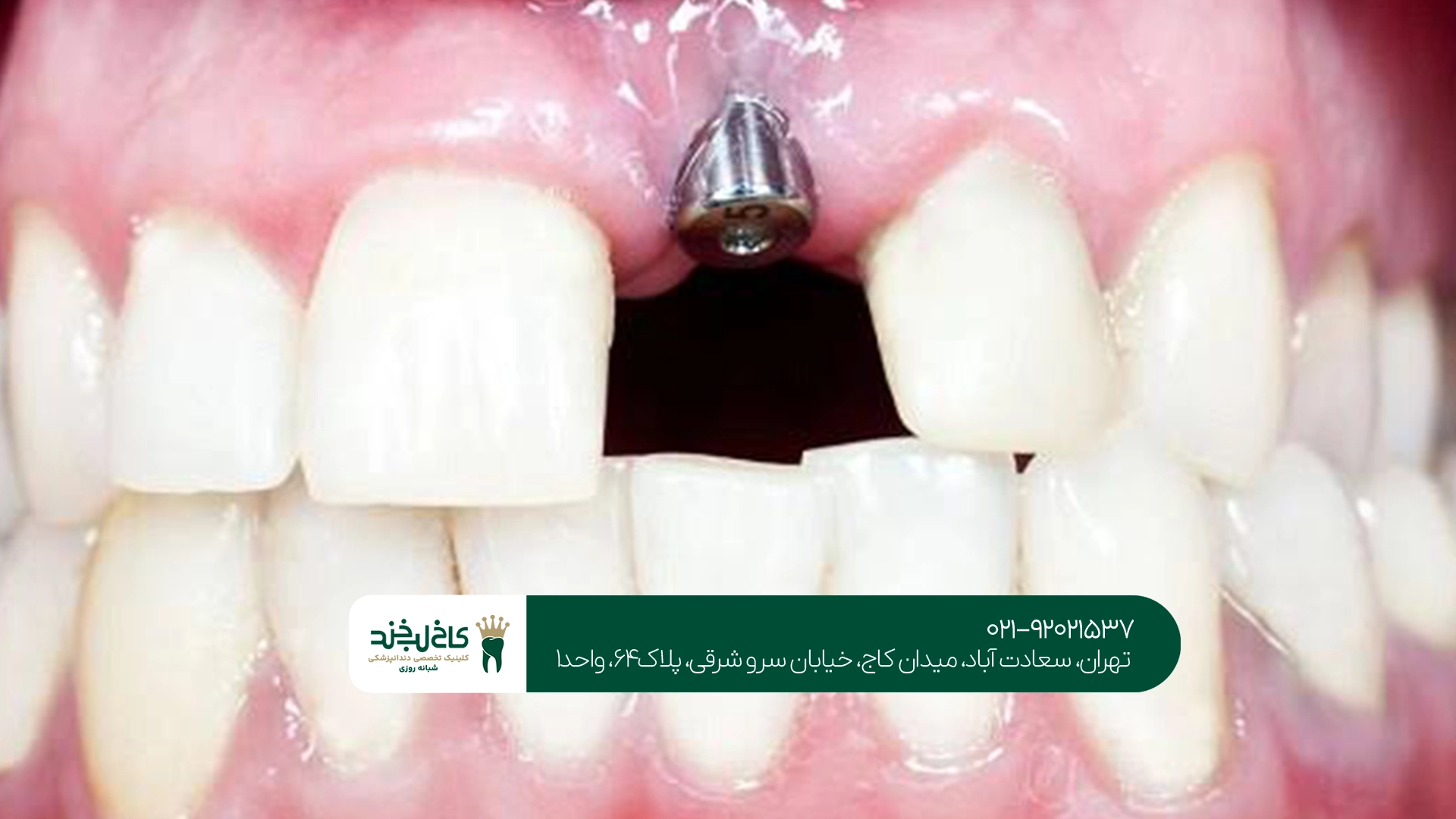 عوامل مؤثر بر هزینه ایمپلنت دندان جلو