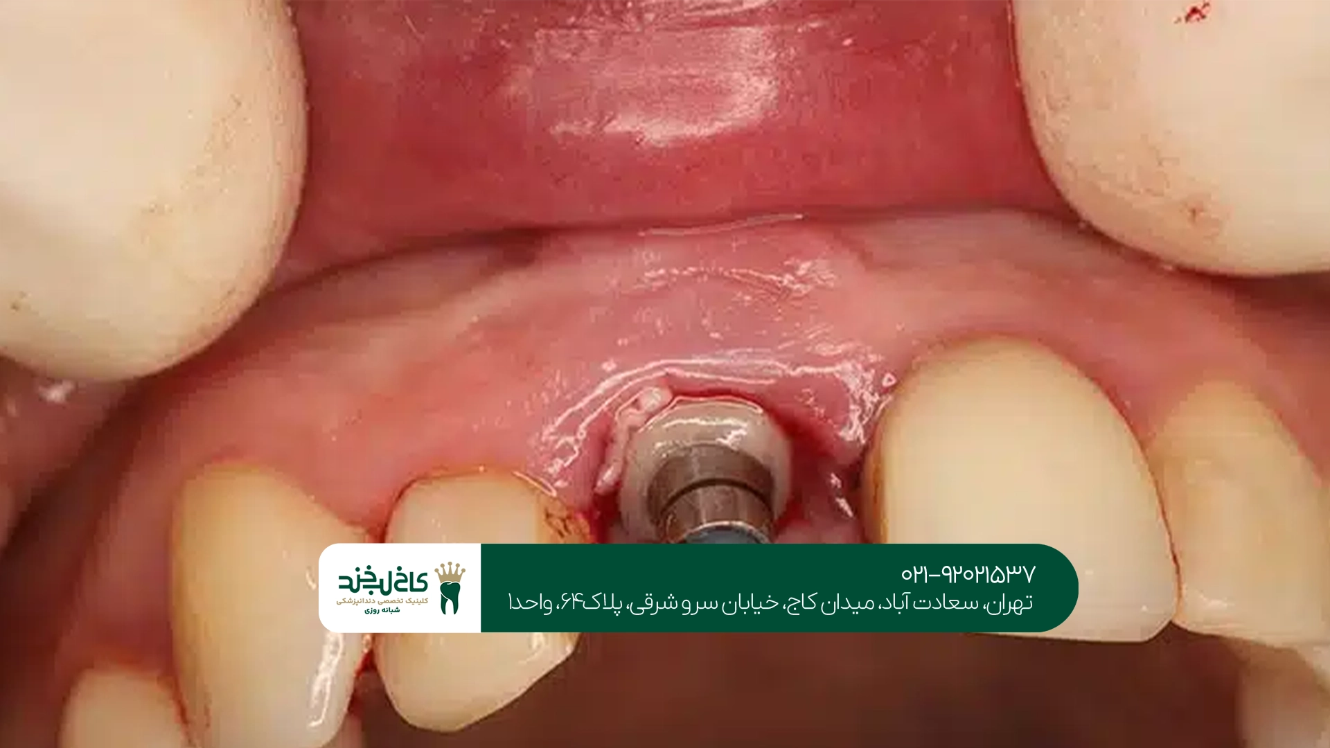 مدت زمان درمان ایمپلنت دندان جلو