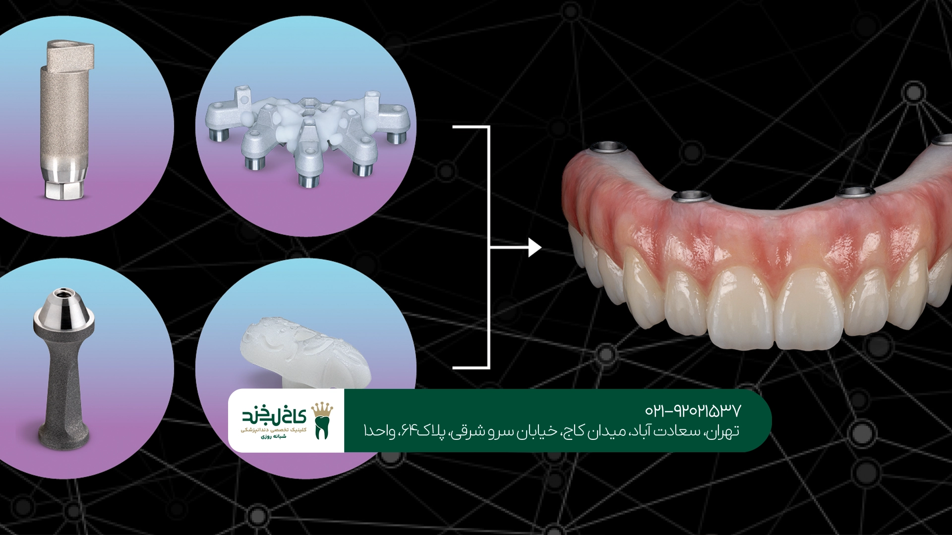 ایمپلنت دندان دیجیتال چیست؟ ایمپلنت دندان دیجیتال چیست؟