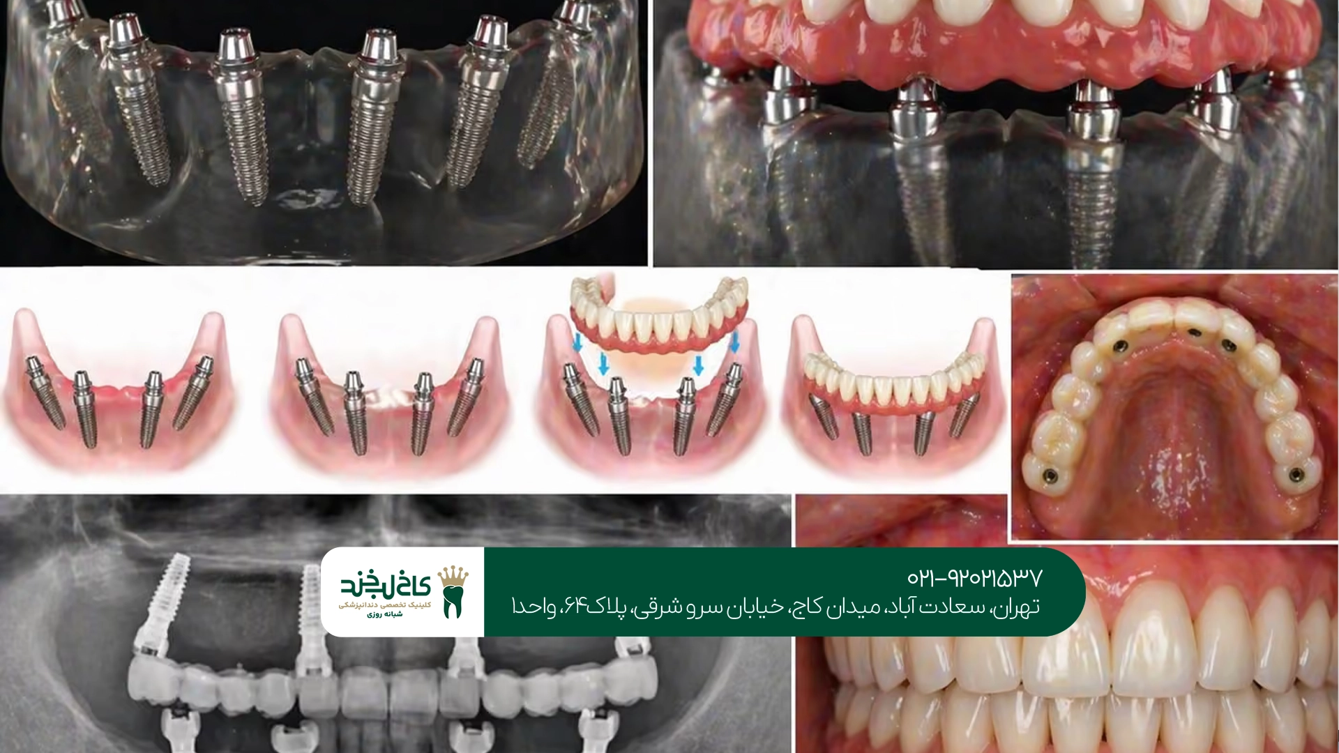 تفاوت ایمپلنت دیجیتال با ایمپلنت معمولی چیست؟ تفاوت ایمپلنت دیجیتال با ایمپلنت معمولی چیست؟