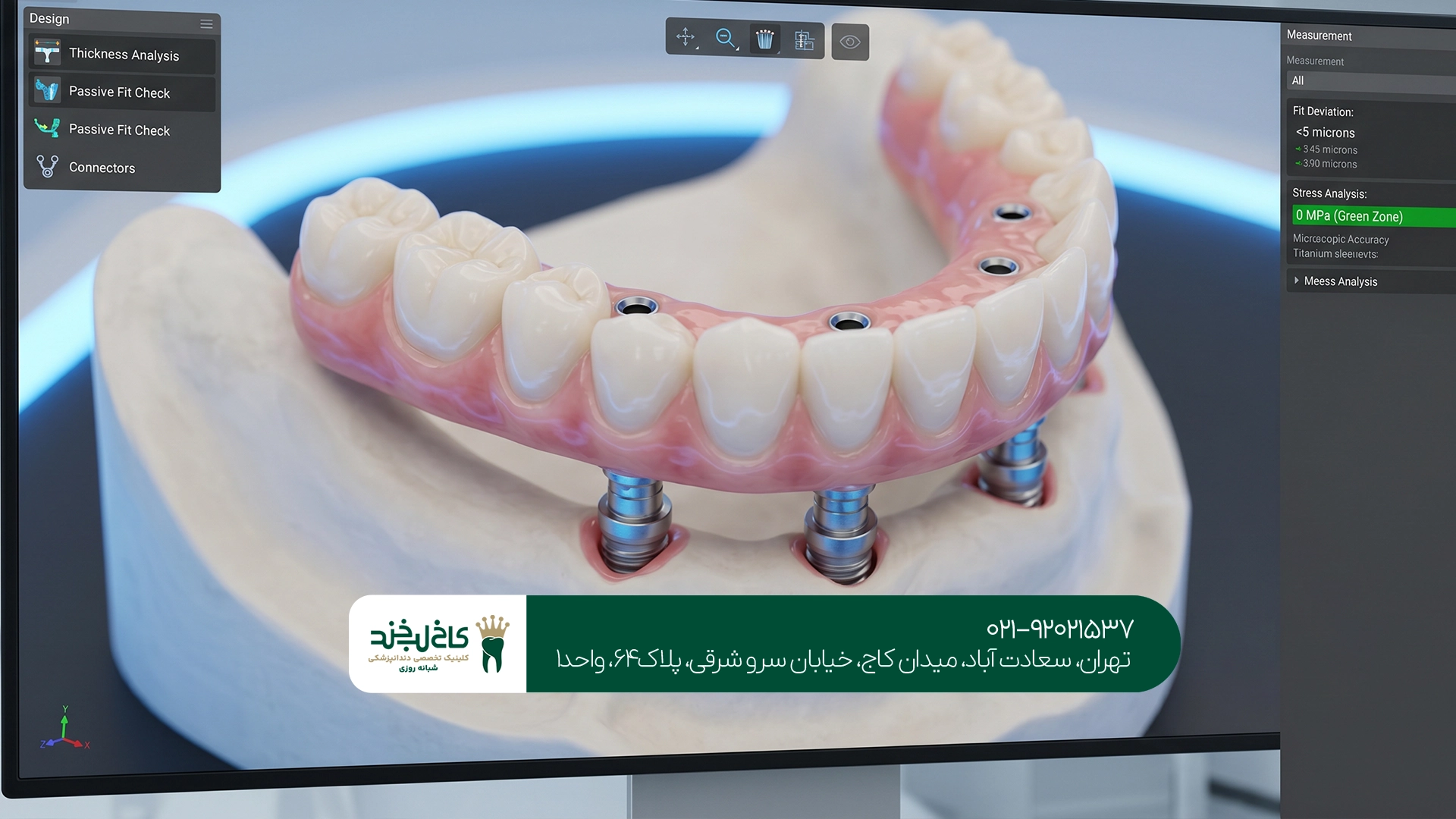 ایمپلنت دیجیتال برای چند دندان ایمپلنت دیجیتال برای چند دندان