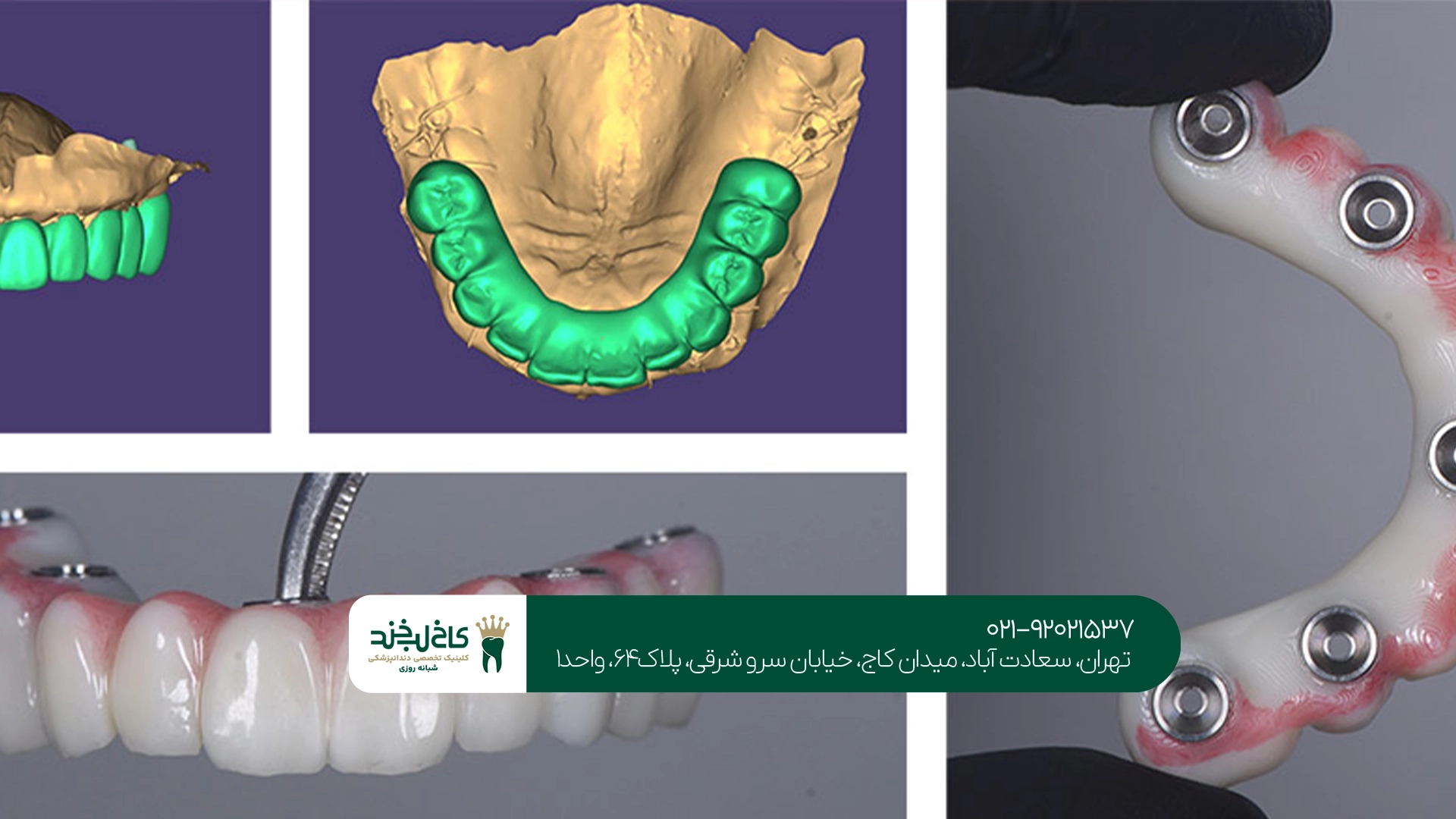 مدت زمان ایمپلنت دیجیتال چقدر است؟ مدت زمان ایمپلنت دیجیتال چقدر است؟