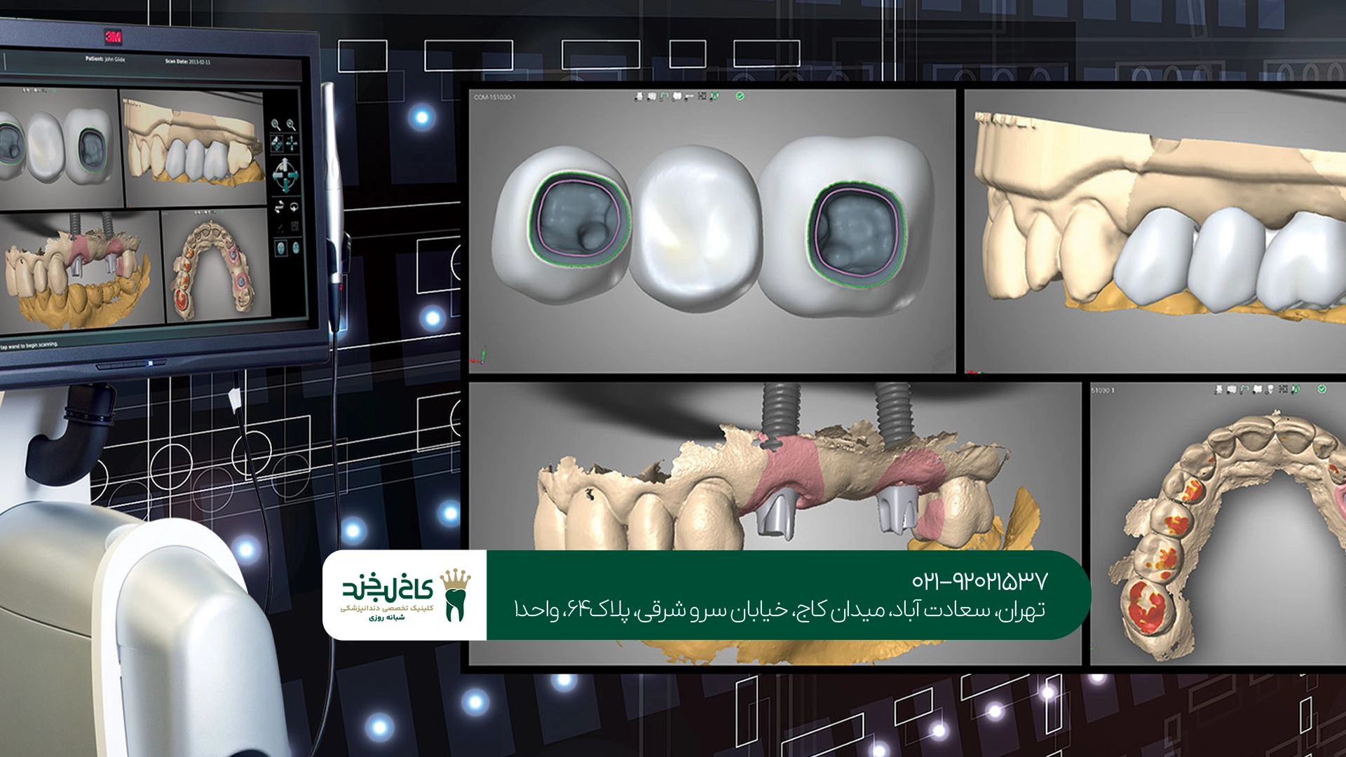 هزینه ایمپلنت دندان دیجیتال هزینه ایمپلنت دندان دیجیتال