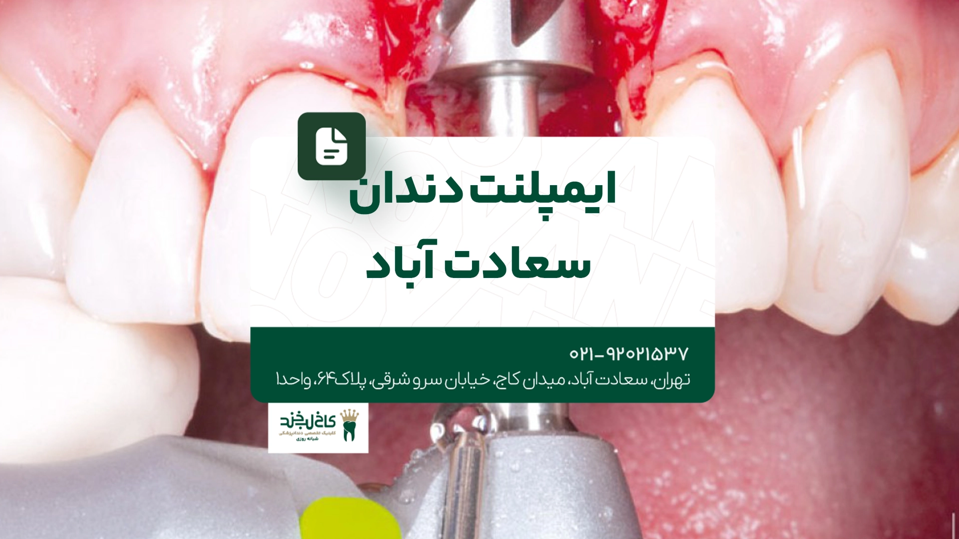 ایمپلنت دندان سعادت آباد