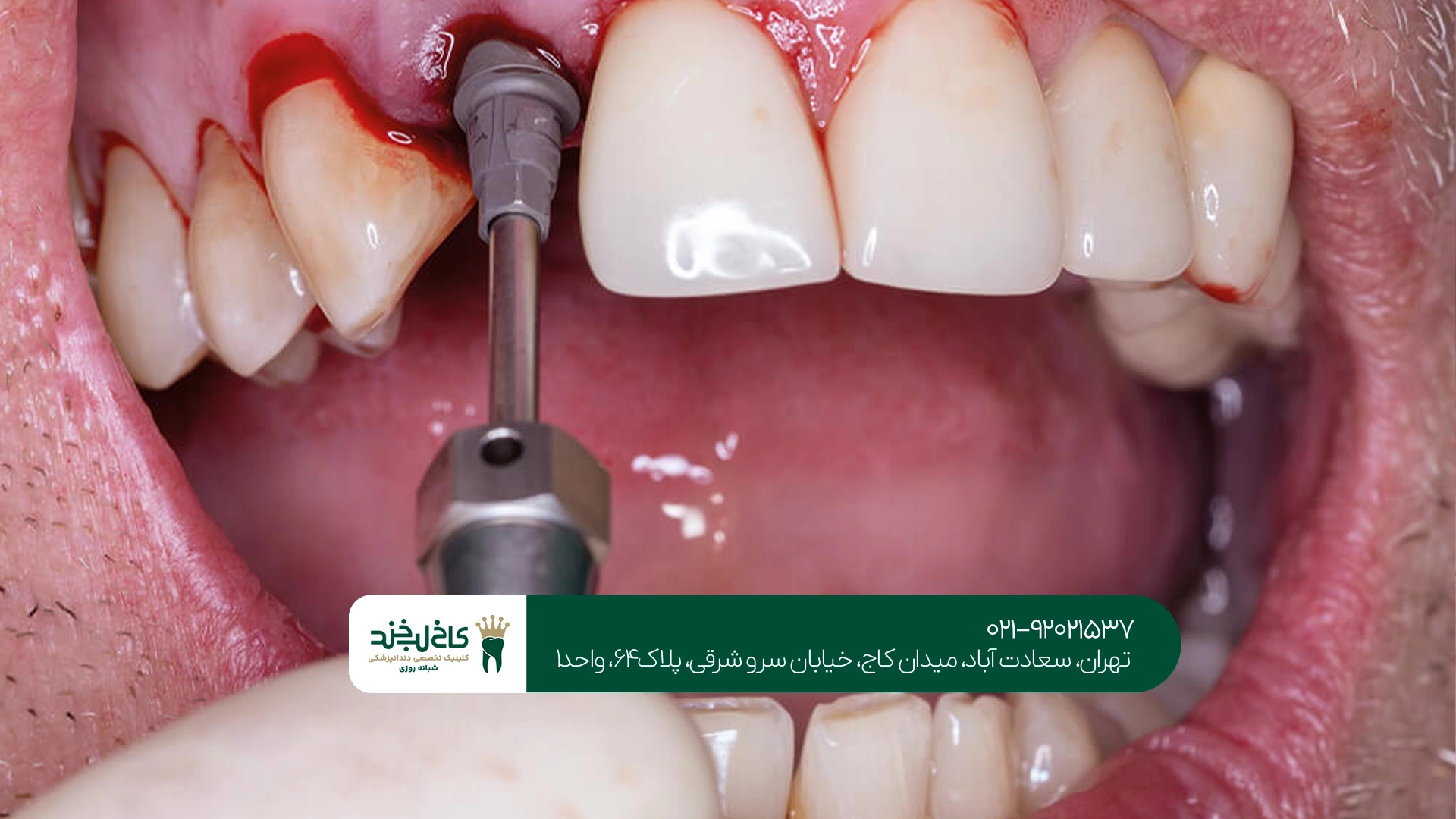 ماندگاری ایمپلنت دندان در سعادت آباد
