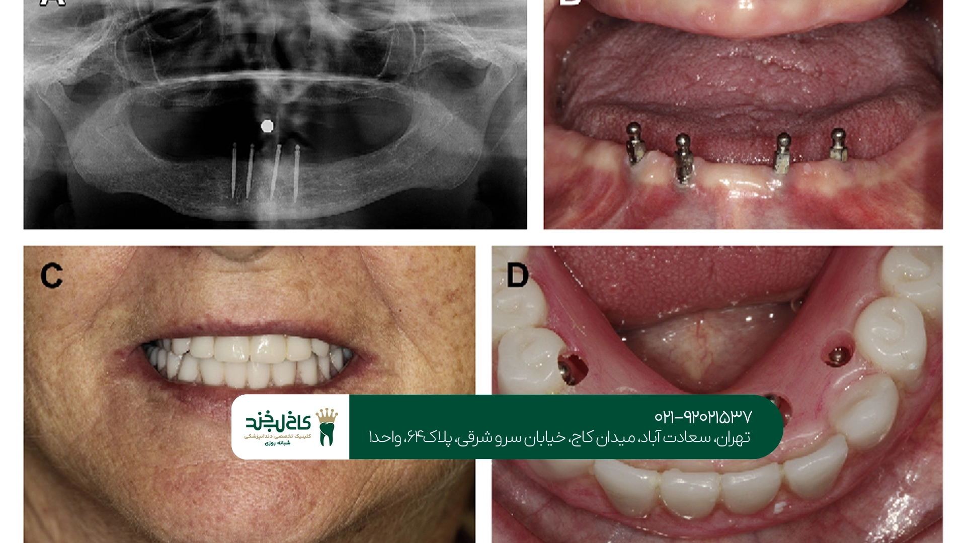 مجهزترین مرکز کاشت ایمپلنت دیجیتال تهران