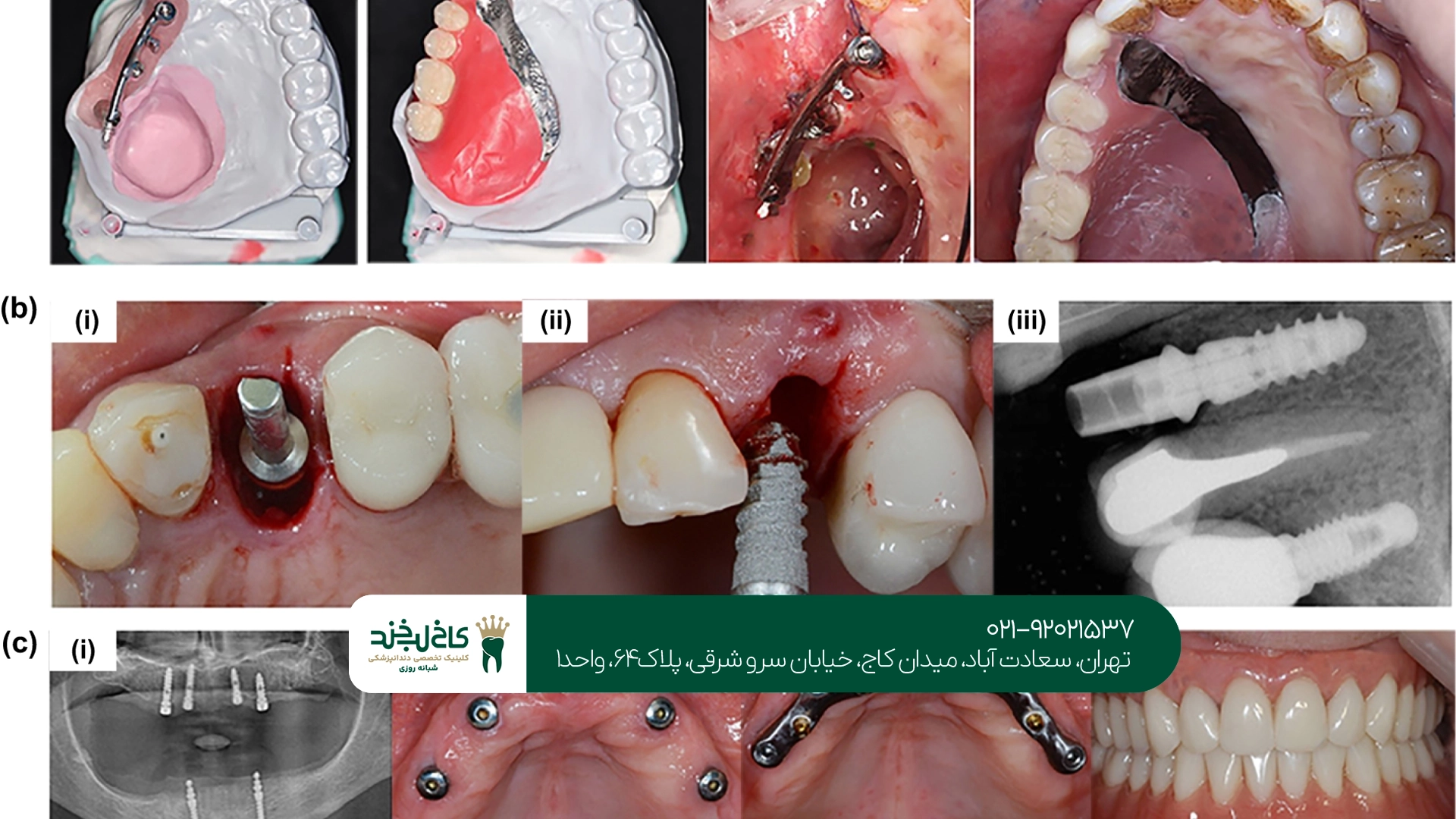 بهترین مرکز ایمپلنت دیجیتال تهران
