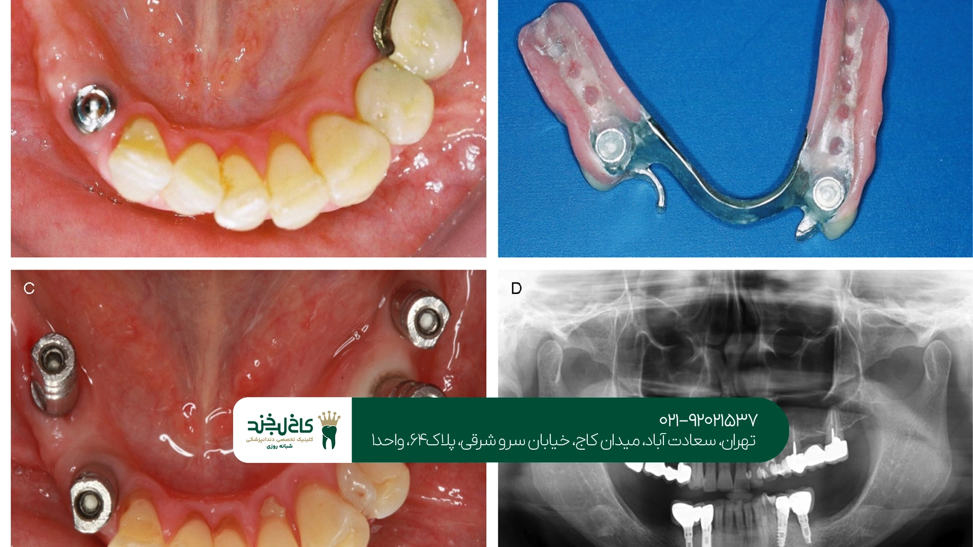 مزایای ایمپلنت دیجیتال برای جایگزینی دندانهای از دست رفته