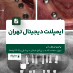 ایمپلنت دیجیتال تهران
