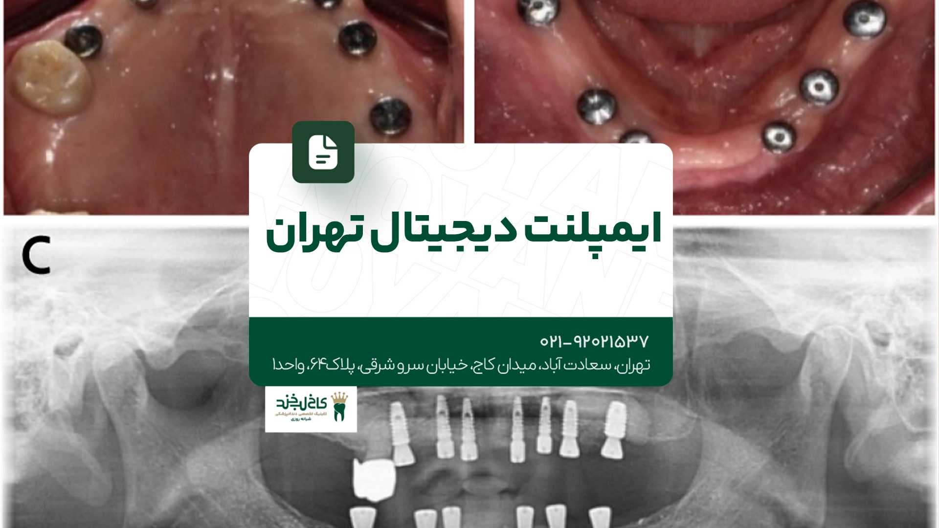 ایمپلنت دیجیتال تهران