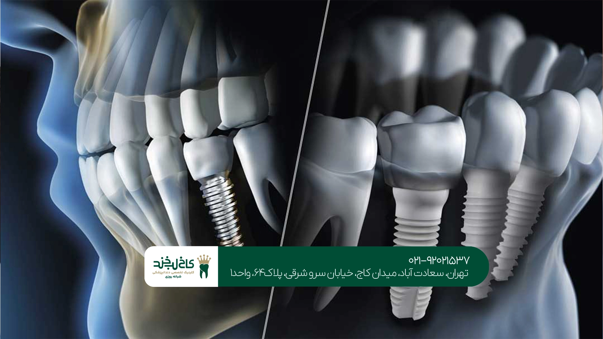 ایمپلنت دیجیتال ایمپلنت دیجیتال