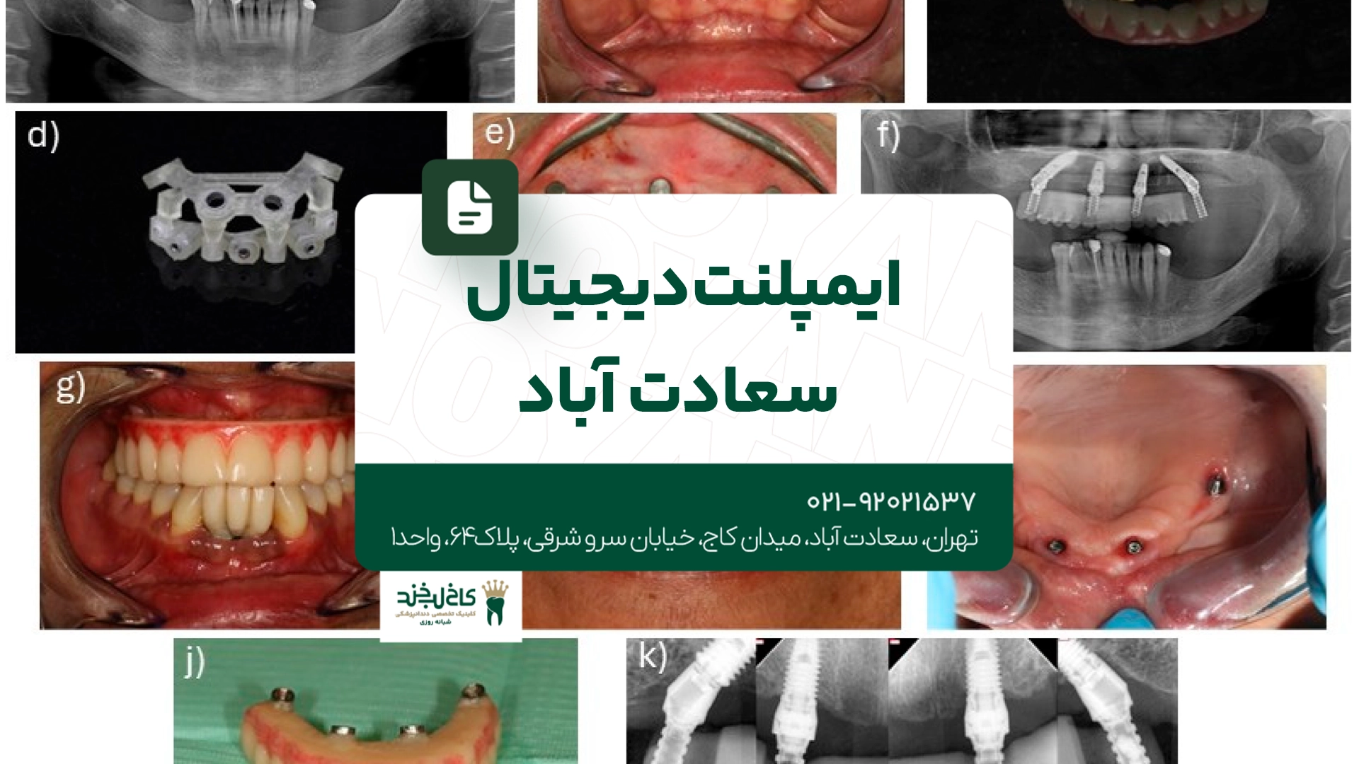 ایمپلنت دیجیتال سعادت آباد ایمپلنت دیجیتال سعادت آباد