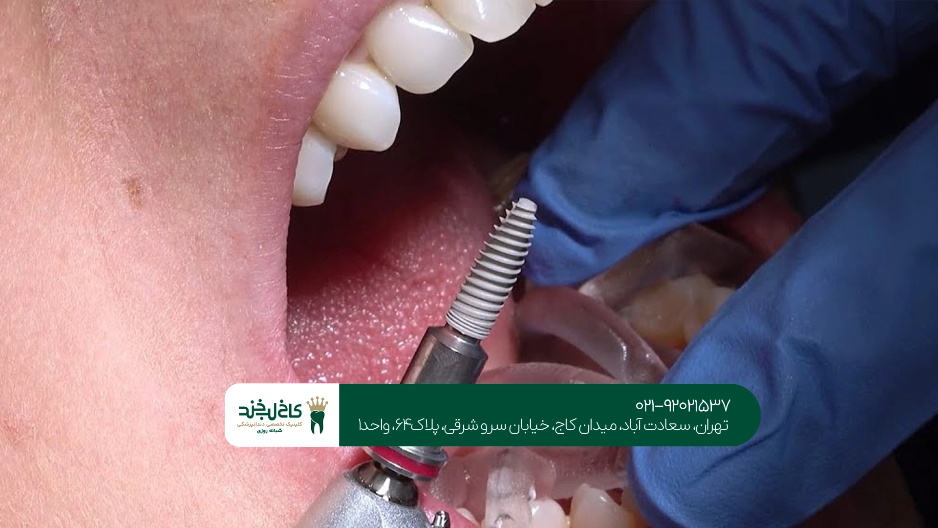 چگونه متخصص ایمپلنت در غرب تهران انتخاب کنیم؟