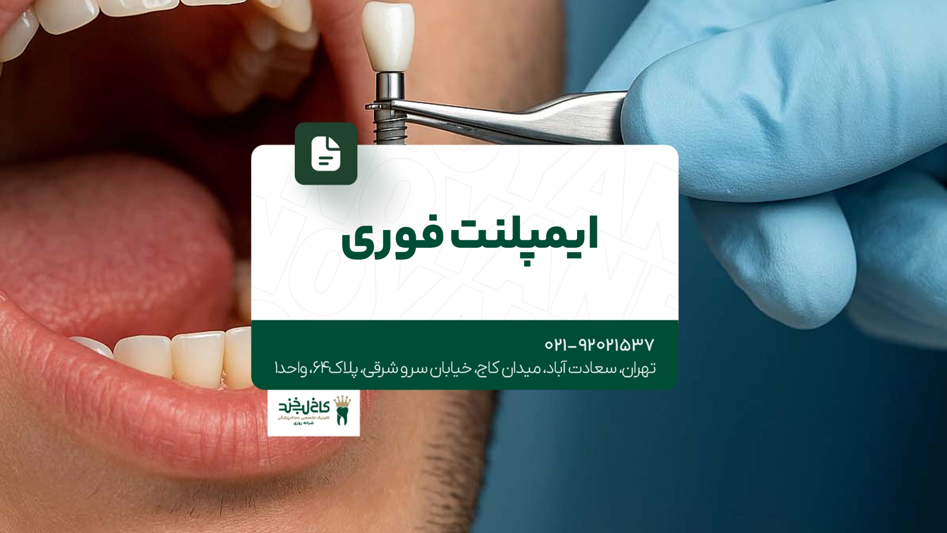 ایمپلنت فوری ایمپلنت فوری