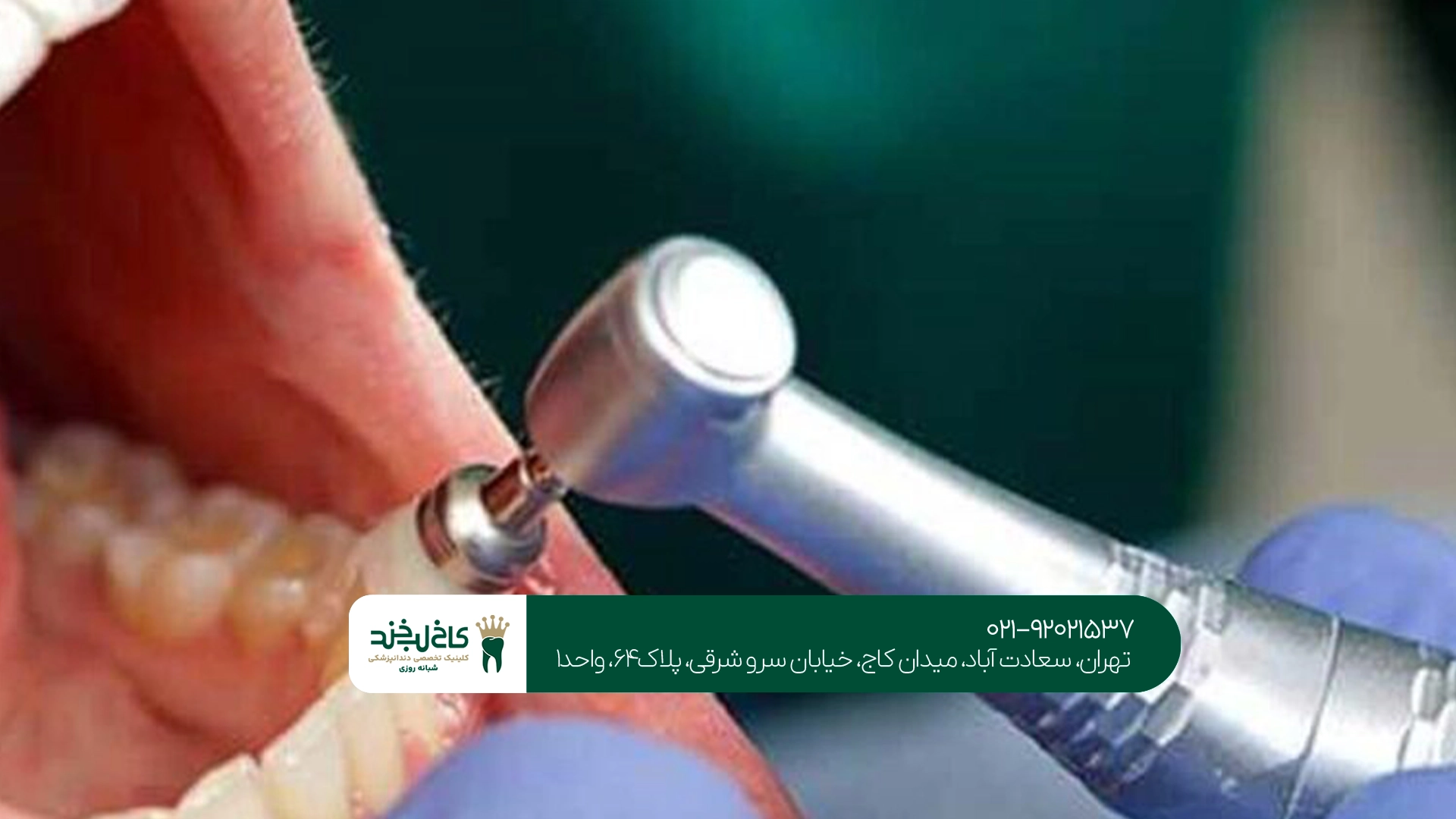 بروساژ دندان برای چه کسانی مناسب است؟