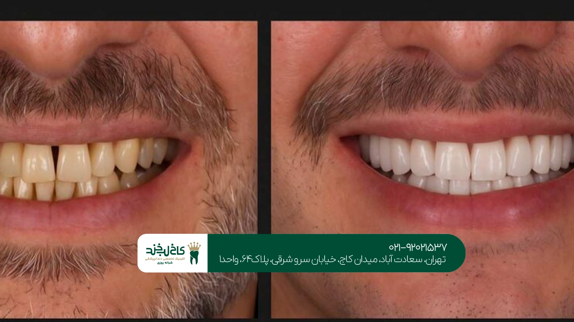 بستن فاصله دندان با لمینت بستن فاصله دندان با لمینت