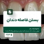 بستن فاصله دندان