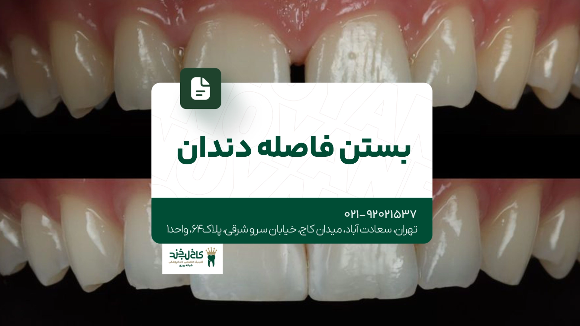 بستن فاصله دندان بستن فاصله دندان