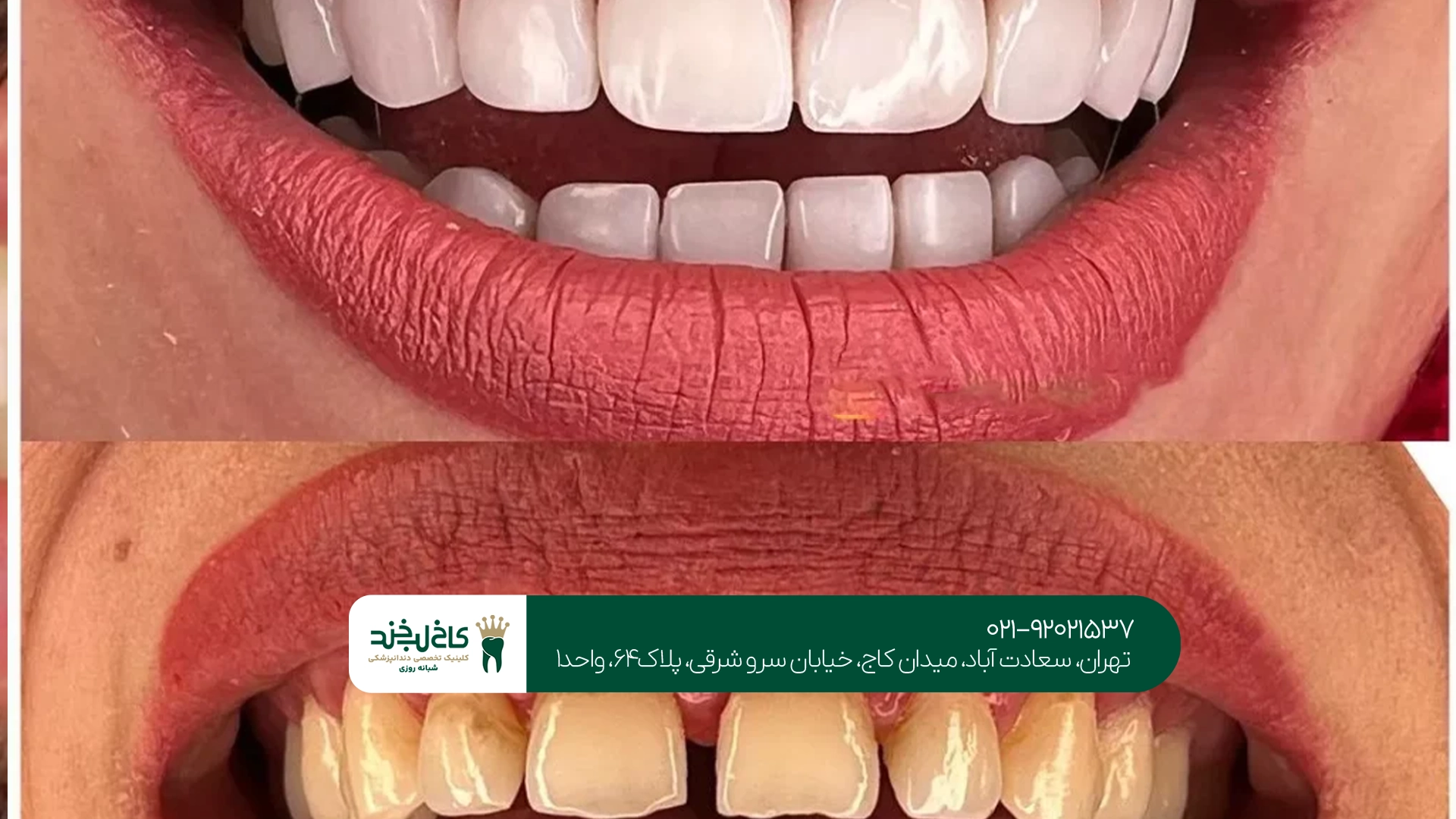 بستن فاصله دندان با کامپوزیت بستن فاصله دندان با کامپوزیت