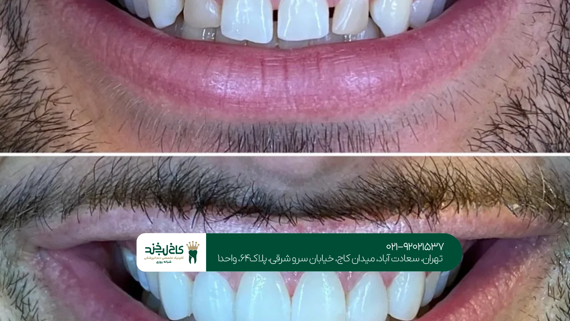 بستن فاصله دندان در تهران بستن فاصله دندان در تهران