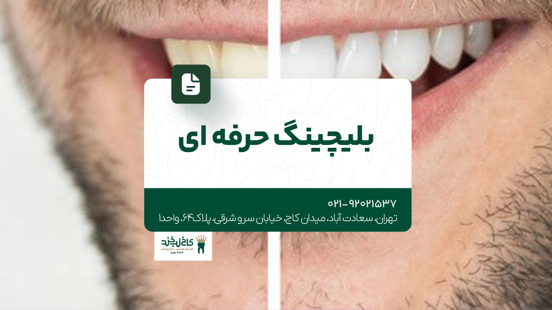 بلیچینگ حرفه ای