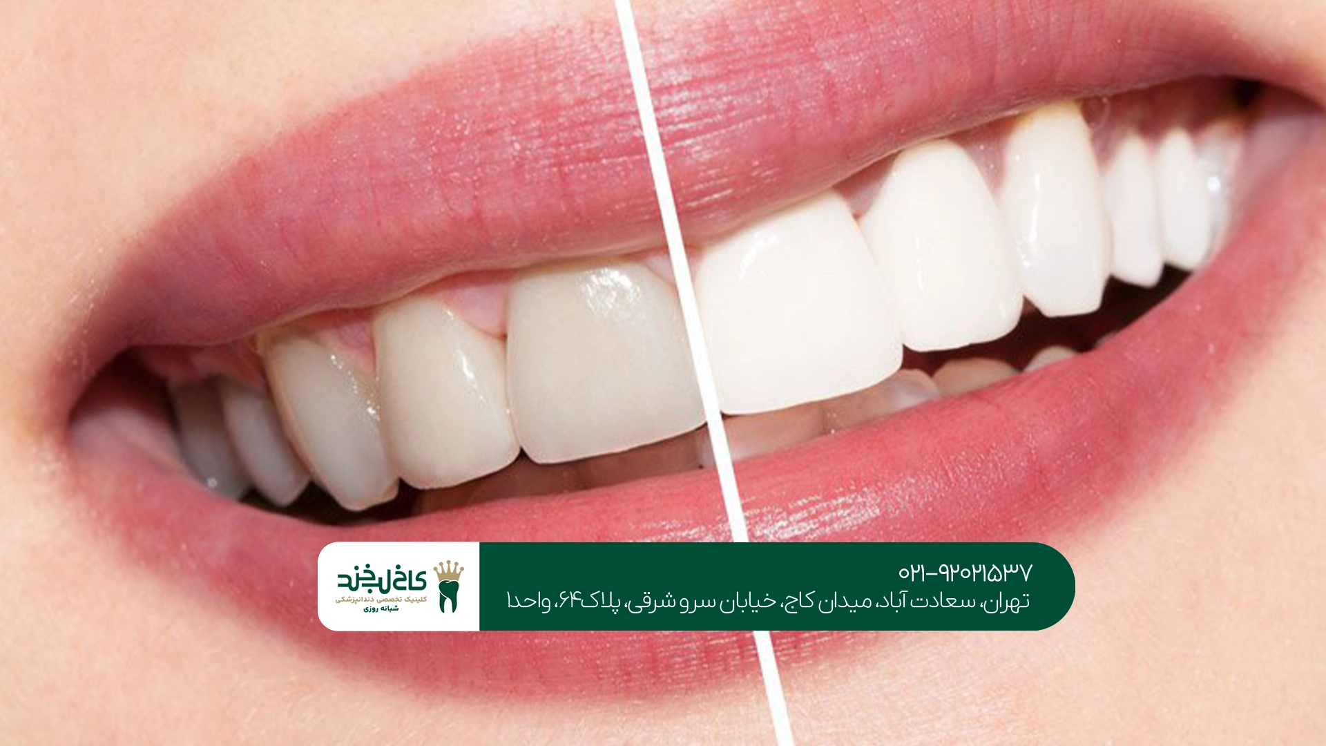 بهترین مرکز بلیچینگ