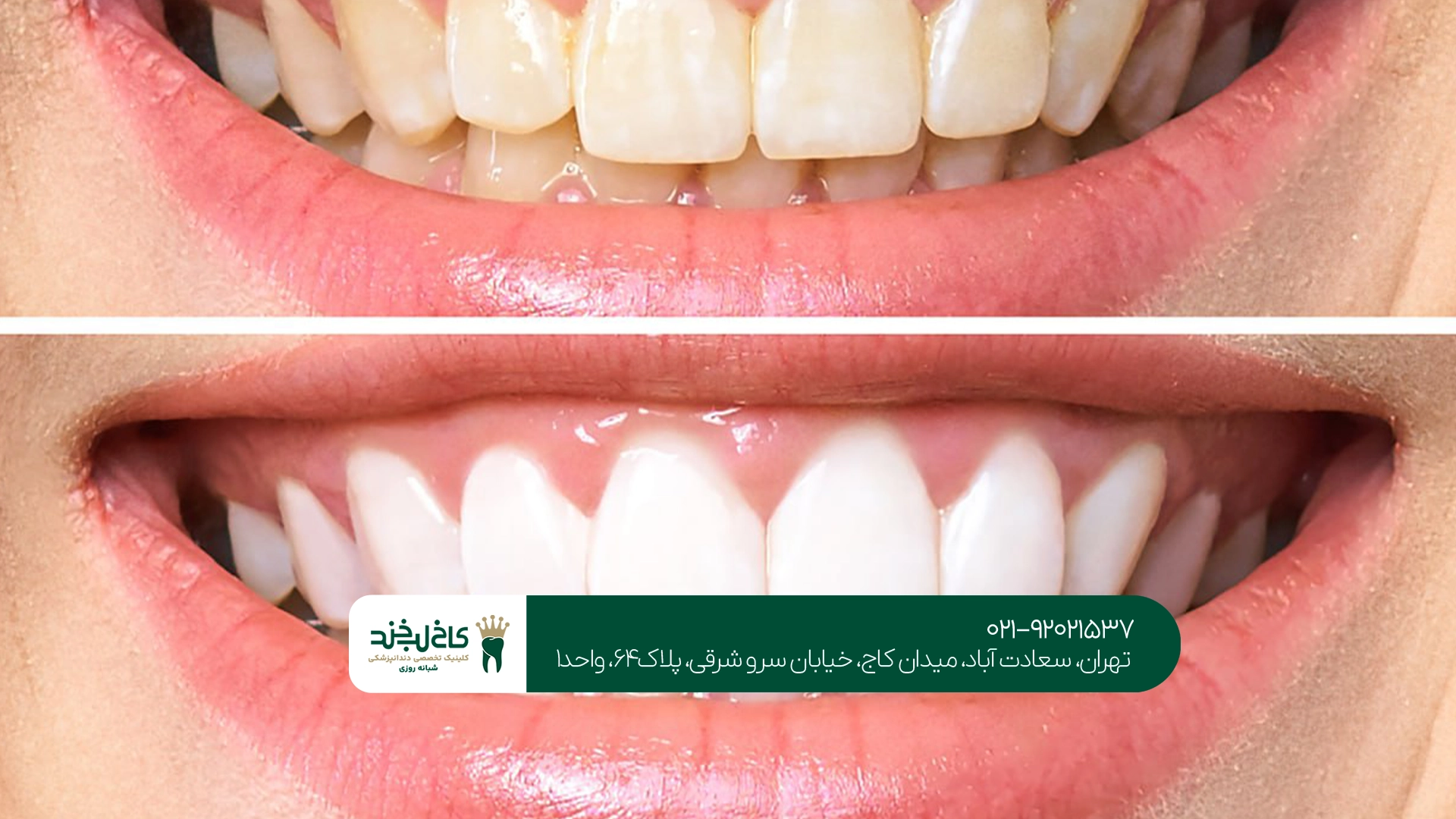 تفاوت بلیچینگ حرفهای و خانگی